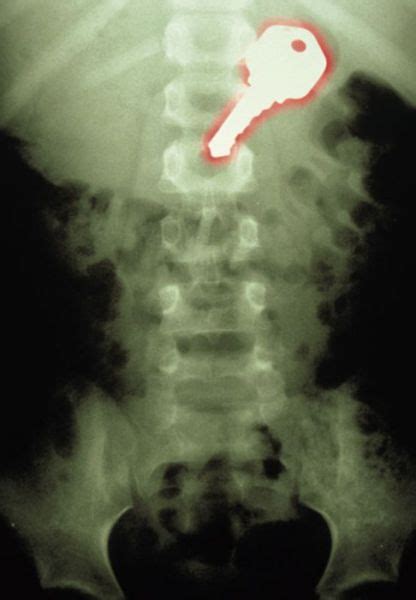 Real X Rays That Will Shock You 22 Pics Izismile Com