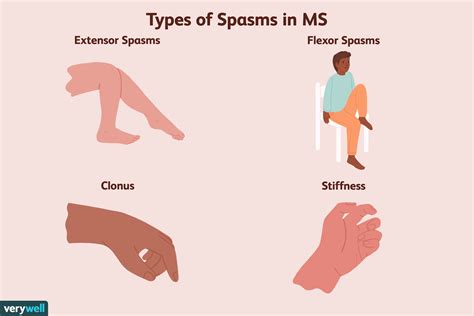 Muscle Spasticity And Stiffness As A Symptom Of Ms