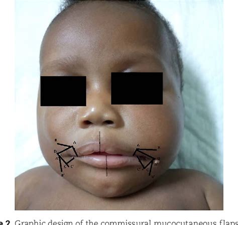 Figure 2 From Bilateral Tessier No 7 Cleft With An Accessory Maxilla