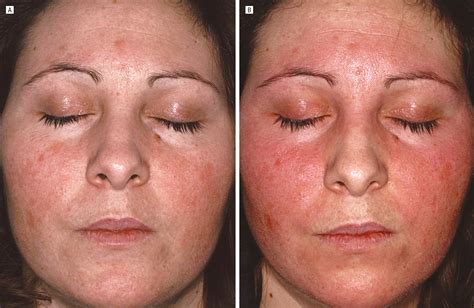 alcohol intolerance and facial flushing in patients treated with topical tacrolimus