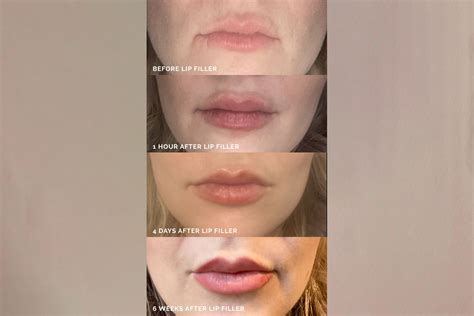 Tales From The Chair Why I Got Lip Injections Plus 8 Most Asked