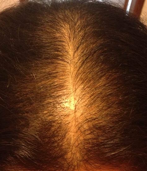 Celiac Disease Hair Loss Reversible Quotes Viral Update