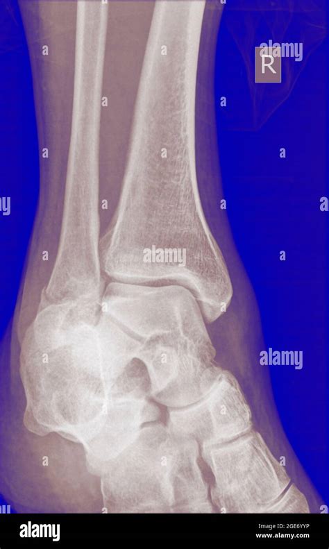 X Ray Of A 43 Year Old Male Patient With A Fracture In The Distal
