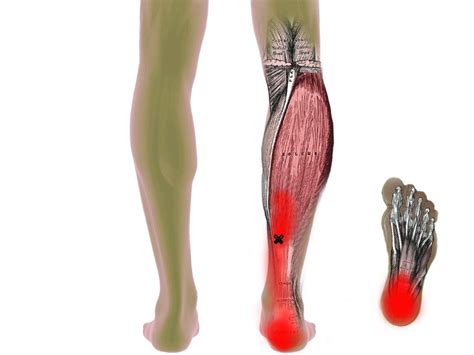 How To Treat Calf Trigger Points