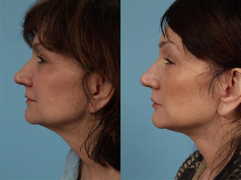 Neck Lift Before And After Photos Patient 336 Chicago Il Tlkm