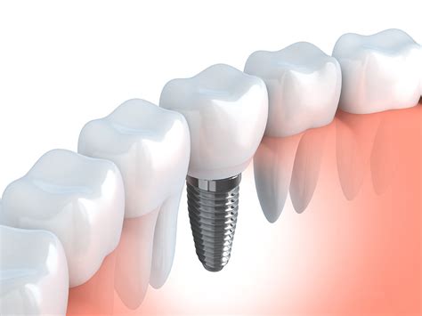 Conheça os 3 tipos de implante dentário Dr Adriano Assis
