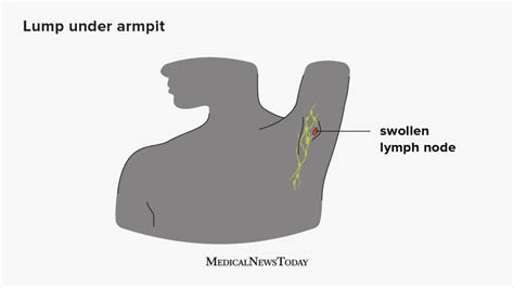 Swollen Lymph Nodes In The Armpit Symptoms Causes And Treatment 2023