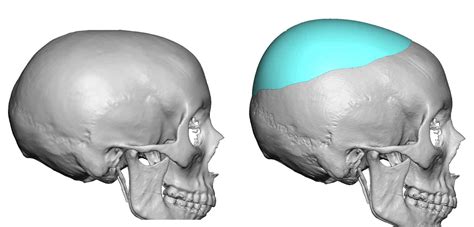 Blog Archivecase Study Custom Crown Skull Implants For Women