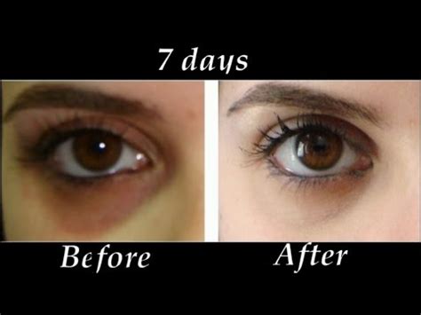 This will slow down blood flow to the area, which reduces how much blood pools under. How to Remove Under eye Dark Circles in 7 days | DIY Dark ...