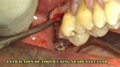 Severely Infected Upper Right Rd Molar Extraction Youtube