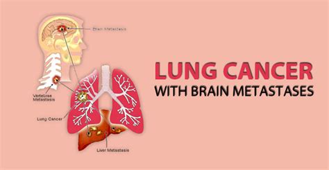 Metastatic Lung Cancer Life Expectancy Avelumab For Patients With