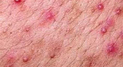 Some rashes in the groin area are minor, but some of these skin rashes indicate a more serious health problem. Top tips for maximizing your CBD products | Heat rash ...