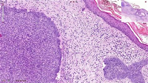 Basal Cell Carcinoma Vs Squamous Cell Carcinoma Histology