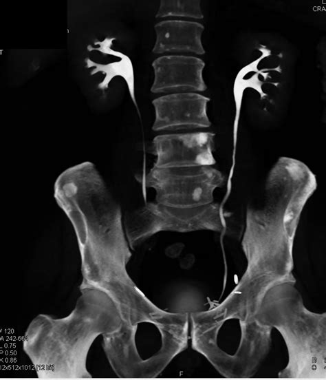 Blastic Bone Metastases From Prostate Cancer Musculoskeletal Case