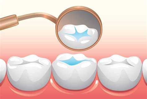 Lakowanie Zębów Na Czym Polega Stomatologia Dla Każdego Projekt Edukacyjny Klinik Z