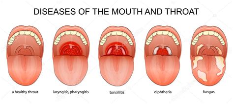 What Does A Healthy Throat Look Like Pictures