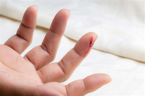 How To Treat A Cut On Your Finger