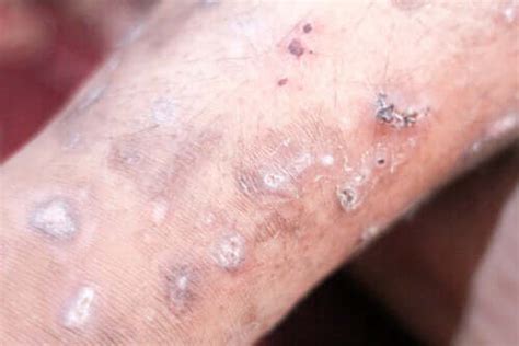 causes symptoms and treatments for scabies step to health