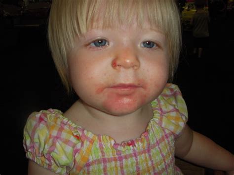 What Does A Food Allergy Rash Look Like For Your Lo Babycenter