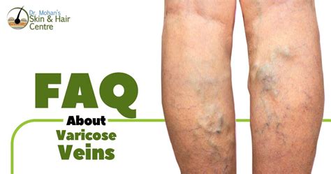 Most Common Questions About Varicose Veins