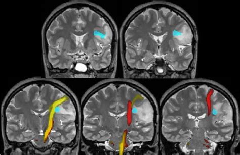 Functional Mri Fmri Queen Square Imaging Centre