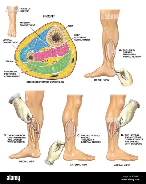 Compartment Syndrome With Four Compartment Fasciotomy Procedure Stock