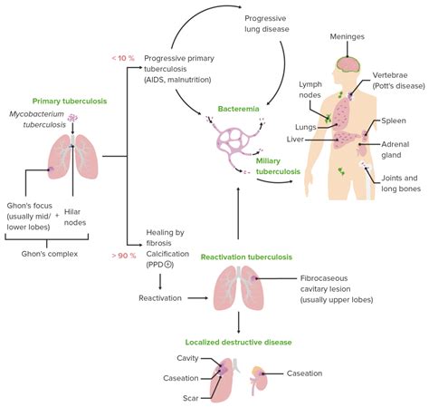 Charts Of Pathology Of Tuberculosis Pathophysiology O