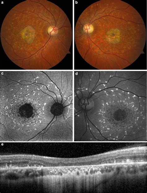 Clinical Applications Of Fundus Autofluorescence In Retinal Disease