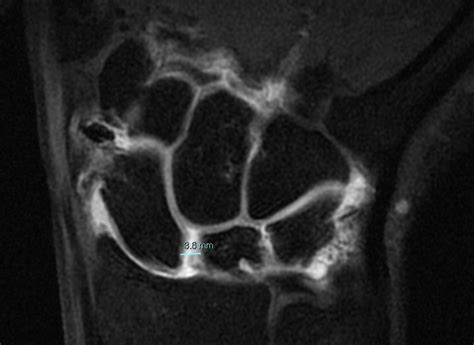 Scapholunate Ligament Tear Cortical Ring Sign Image Radiopaedia Org