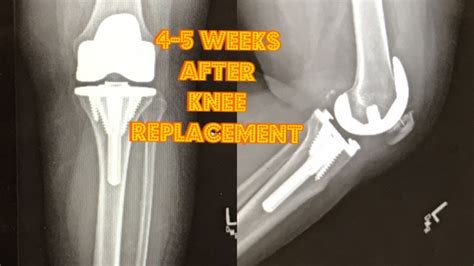 Total Knee Replacement Surgery 4 5 Week Post Op Recovery Log Update