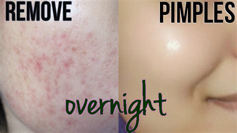 how to remove pimples overnight acne scar treatment youtube