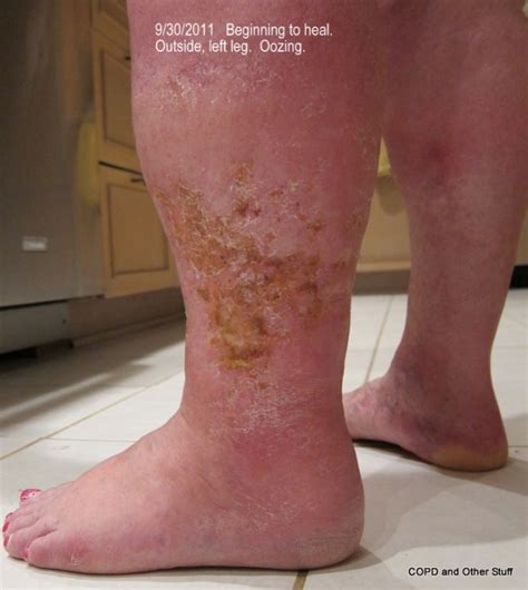 Cellulitis Copd And Other Stuff