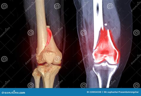 Ct Knee Joint 3d Rendering Image Front View And Coronal View Isolated