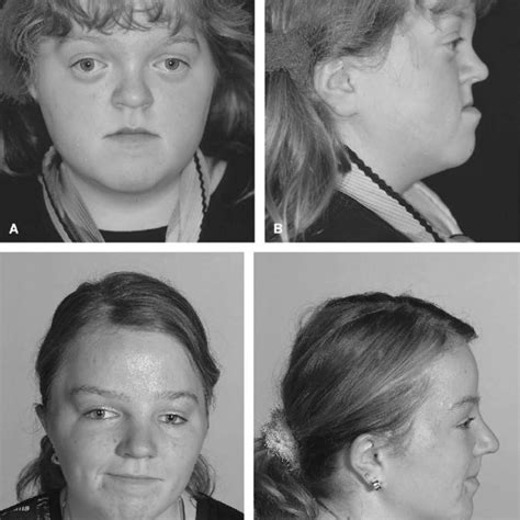 Patient 5 With Apert Syndrome With Mild Mental Retardation Who Had