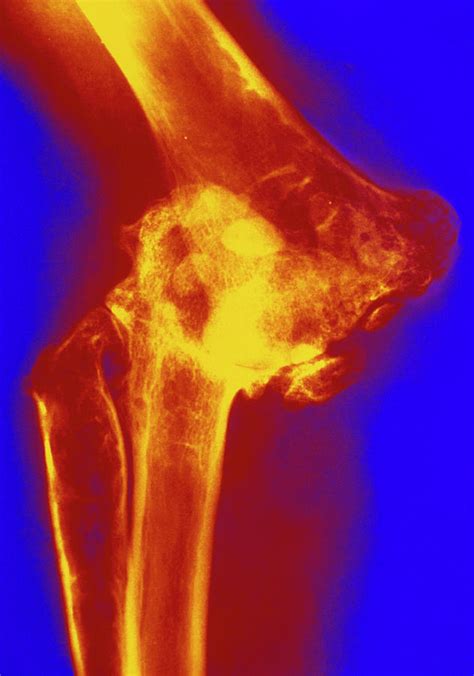 Col X Ray Of Rheumatoid Arthritis Of The Elbow Photograph By Medical Photo Nhs Lothianscience