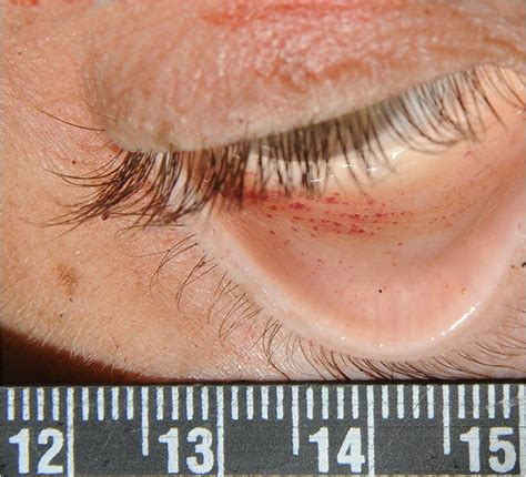 Petechial Hemorrhages In The Palpebral Conjunctiva Of The Right Lower