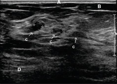Breast Ultrasound Past Present And Future Intechopen