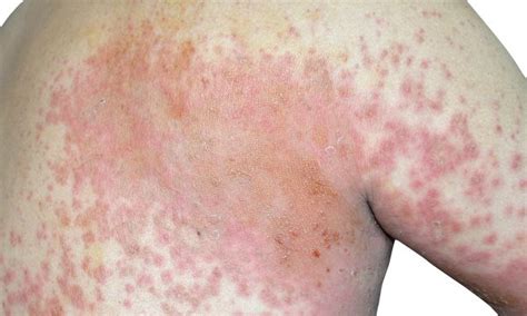 Hiv Rash Early Symptom Of A Serious Disease Ucsf Ahp Org