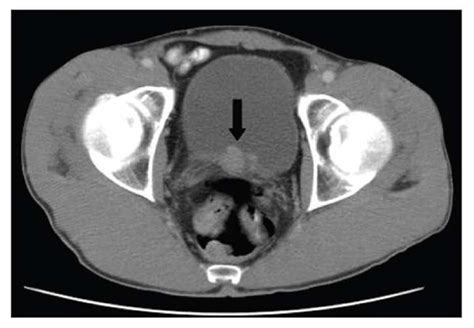 Can You See Bladder Cancer On A Ct Scan Updated