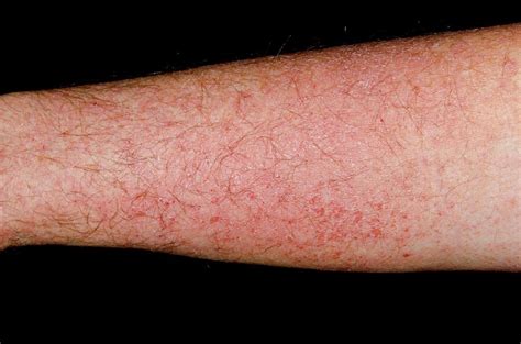 Photosensitive Rash On The Arm Photograph By Dr P Marazziscience