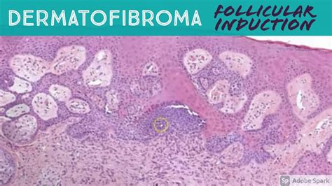 Dermatofibroma With Basaloid Follicular Induction Mimicking Bcc Youtube
