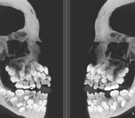 Start photoshop and load an image of the person and an image of an xray skull, these are the images we will use to create the final image. A toddlers skull - image - oddlyterrifying - Reddit | Creepy images, Hyperdontia, Skull