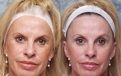 Face Exercises For Regaining A More Youthful Look Botox