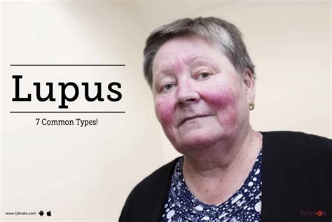 Lupus 7 Common Types By Dr Lipy Gupta Lybrate