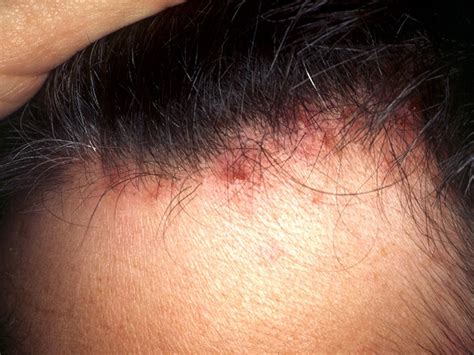 Scalp Folliculitis Symptoms Pictures Causes Shampoos And Creams