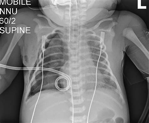 Association Of Pneumothorax With Use Of A Bougie For Endotracheal