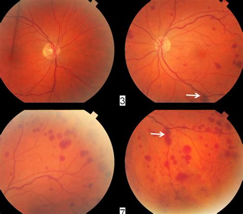 Ischemic Ocular Syndrome Color Fundus Photographs The Retina Reference