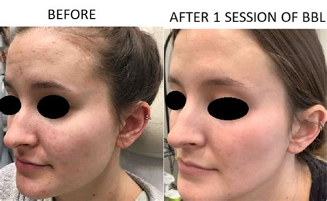 bbl before and after photos patient 14 washington dc mi skin dermatology center melda isaac md