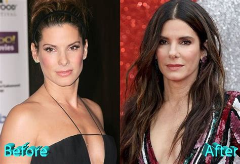 Sandra Bullock Plastic Surgery Speculations Sparked By Oscar Appearance