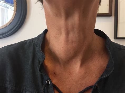 how do you treat someone with a benign nodule with rfa thyroid center of santa monica